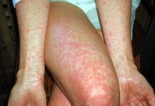 México supera los 7 mil 300 casos de sarampión; Colima mantiene incidencia por encima de la media nacional