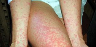 México supera los 7 mil 300 casos de sarampión; Colima mantiene incidencia por encima de la media nacional