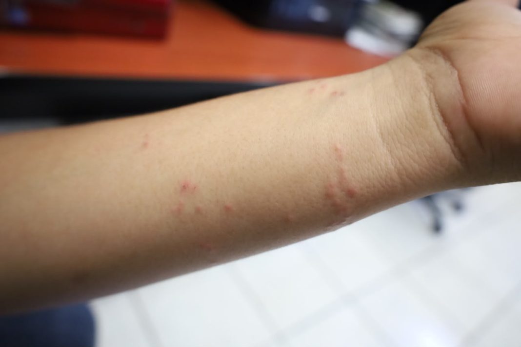 alergia 01
