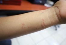 Salud Colima exhorta a identificar factores por alergia y acudir a recibir atención médica gratuita
