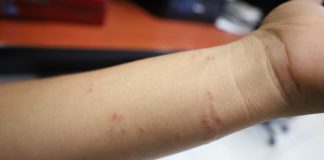 Salud Colima exhorta a identificar factores por alergia y acudir a recibir atención médica gratuita